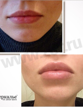 Контурная пластика губ, препарат Juvederm Ultra 3 1ml. Работа врача-косметолога Даниловой Яны Евгеньевны